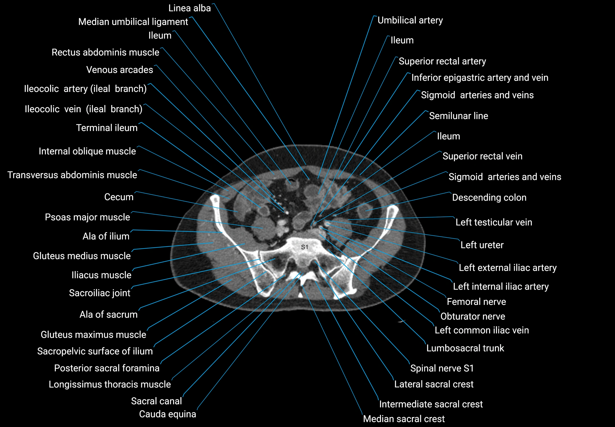 CT male pelvis axial cross sectional anatomy labelled radiology image -00141.webp